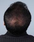 After Hair Transplant&nbsp;2 Sessions (Areas)